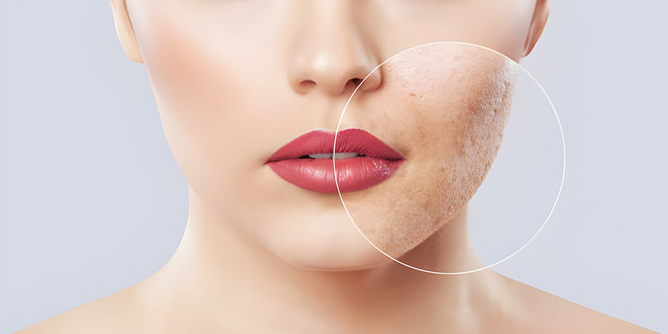 Acne Scars  
  Minimize acne scars with advanced solutions like laser, peels, and microneedling. Restore even skin texture and confidence with expert care.