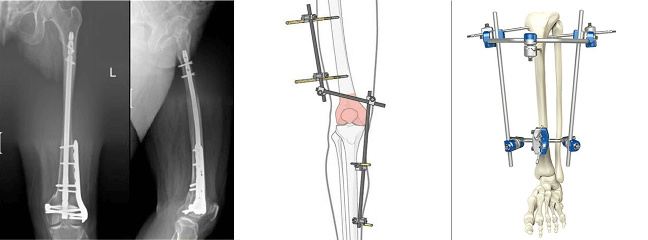 Femur & Tibial Fracture Fixation 
  Precise fixation of femur and tibia fractures—using modern implants for stable alignment, faster healing, and return to normal activity.