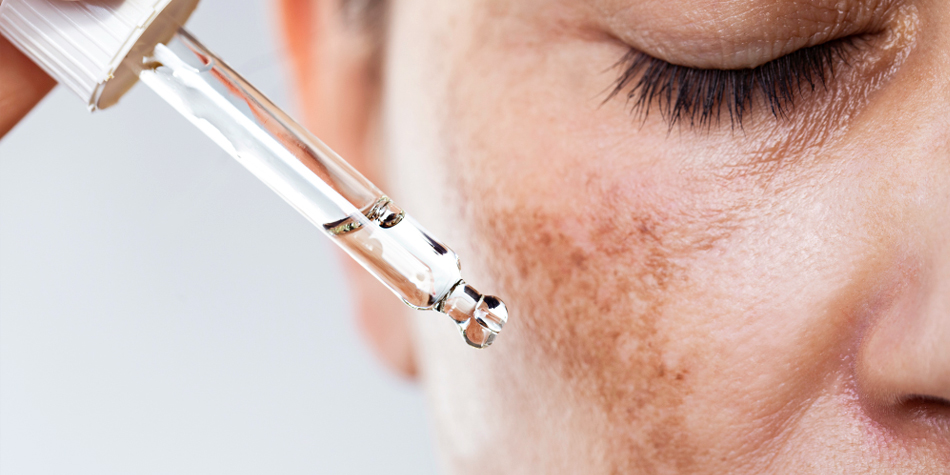 Pigmentation / Melasma  
  Target stubborn pigmentation, tanning, and melasma with customized treatments that even out skin tone and restore natural brightness.