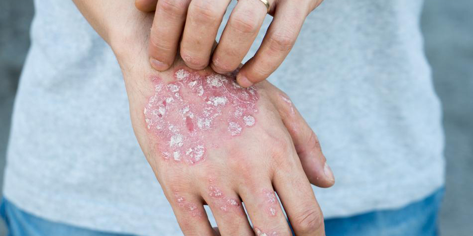Psoriasis and Eczema  
  Soothing care for itchy, red, and flaky skin caused by psoriasis or eczema. We help manage flare-ups and restore comfort.