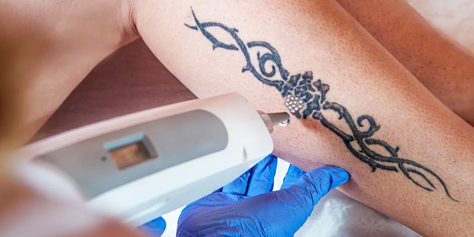 Tattoo Removal
  Advanced laser technology breaks down tattoo ink safely and effectively, fading unwanted tattoos with precision and care.