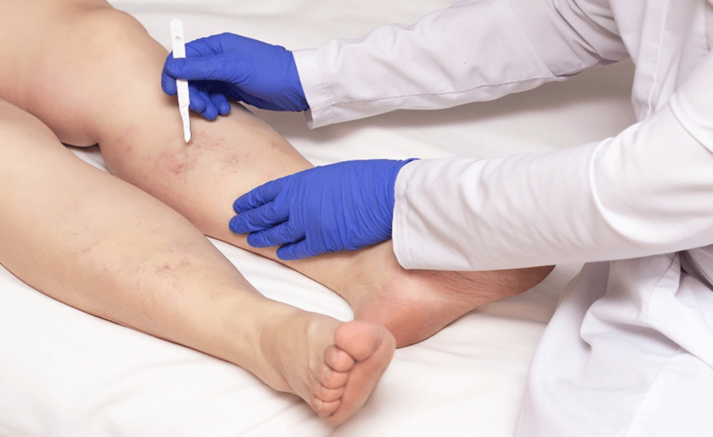 Vascular Surgery
Vascular surgery involves treating diseases of blood vessels like varicose veins, arterial blockages, and aneurysms. It restores proper blood flow and prevents serious complications like stroke or limb damage.
READ MORE