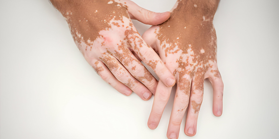 Vitiligo 
  Manage white patches and pigmentation loss with advanced therapies like phototherapy and topical treatments to help restore skin tone.