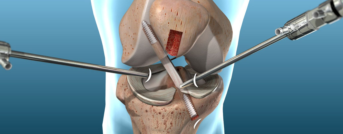 ACL Reconstruction 
  Restore knee stability and function with advanced ACL reconstruction—ideal for sports injuries, ensuring strong recovery and return to active life.