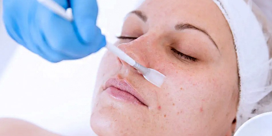 Chemical Peels  
  Gently exfoliate dull or damaged skin to reveal a smoother, brighter, and even-toned complexion with our medically supervised chemical peel treatments.