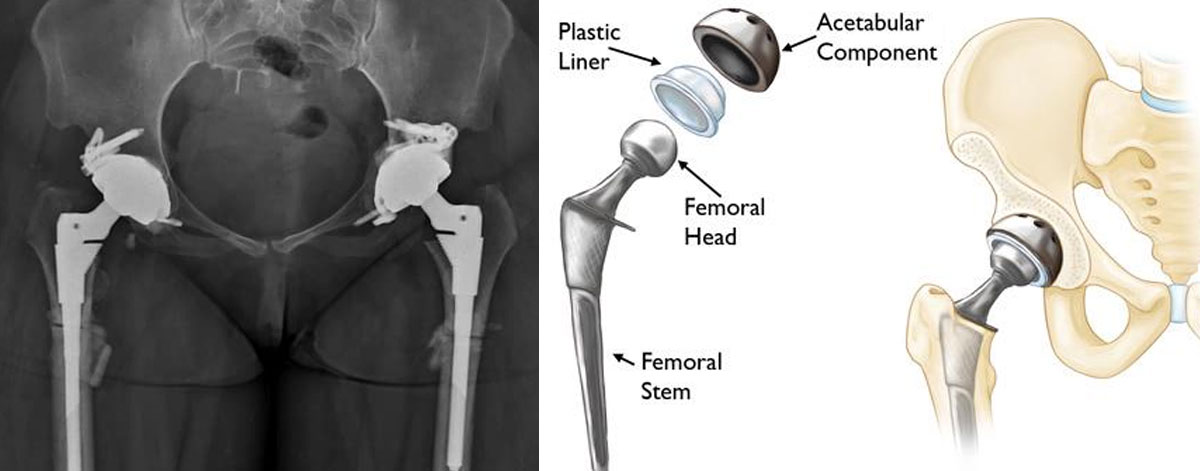 Complex Hip Replacement
  Specialized care for complicated cases or failed previous surgeries—restoring joint function with precision techniques and customized implants.