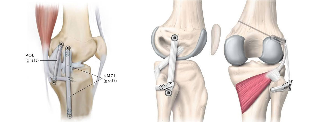 Complex Ligament Reconstruction 
  Specialized treatment for multi-ligament injuries—restoring knee strength, stability, and function through advanced surgical techniques and personalized rehab.