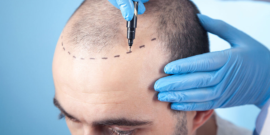 Hair Transplantation  
  Achieve permanent hair restoration with advanced hair transplant techniques. Natural-looking results that restore hairlines and confidence with minimal downtime.