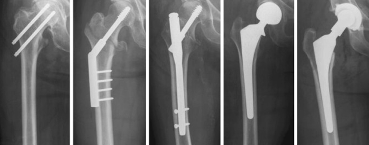 Hip Fracture Fixation / Replacement
  Advanced surgical treatment for hip fractures—fixation or replacement based on age and injury type, ensuring pain relief and early mobilization.
