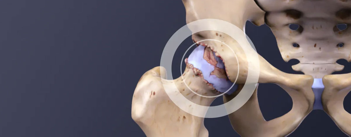Medical Management (Medication) 
  Control pain and inflammation with tailored medications—supporting daily comfort and joint function in hip arthritis.
