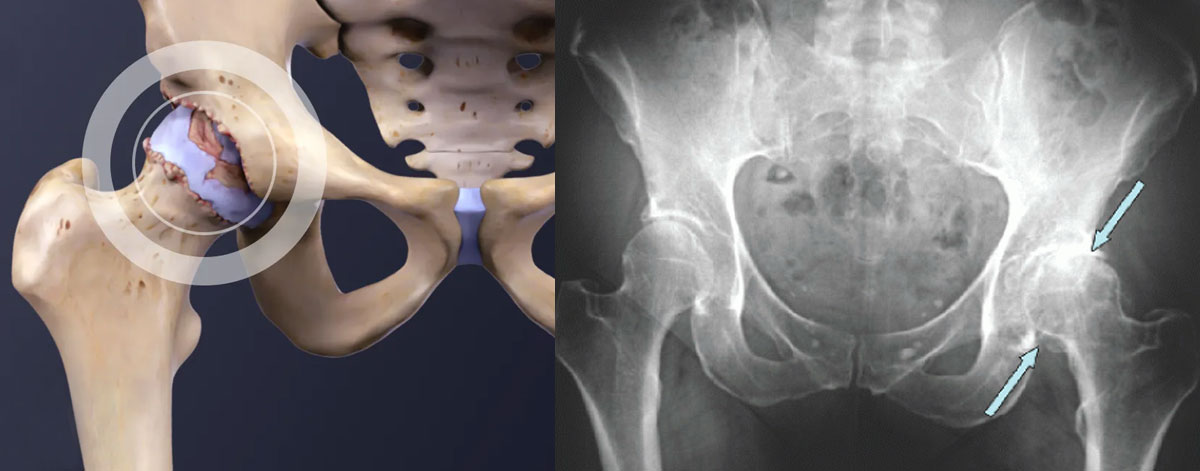 Hip Osteoarthritis 
  Comprehensive care for hip osteoarthritis—reducing stiffness, easing pain, and improving movement through personalized treatment plans and expert evaluation.