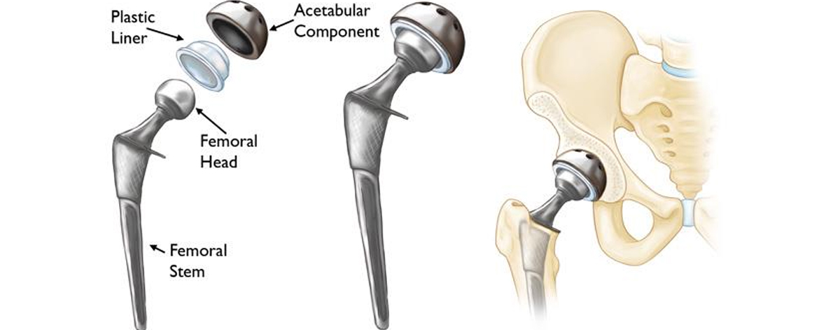 Hip Replacement
  Effective surgical solution for advanced hip arthritis—relieving pain and restoring mobility with total or partial joint replacement using advanced techniques.