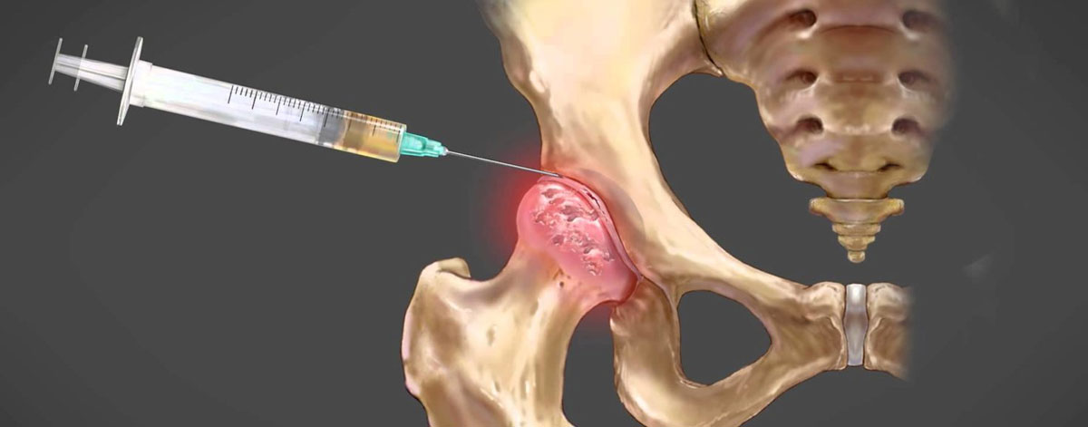 Medical Management (PRP Injection)
  Stimulate healing and reduce pain with Platelet-Rich Plasma (PRP) therapy—natural, non-surgical relief for early hip joint degeneration.