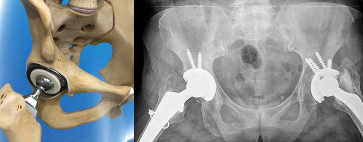 Total Hip Replacement
  Complete replacement of the hip joint with a durable implant—ideal for severe arthritis or injury, ensuring lasting relief and better movement.