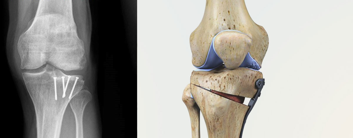 Joint Preservation Surgeries
  Advanced surgical options to preserve your natural knee joint—ideal for early-stage damage, maintaining function, and delaying joint replacement.