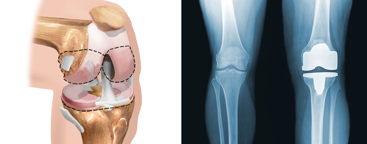 Joint Replacement 
  Effective solution for severe arthritis—replacing the damaged joint with an artificial implant to restore pain-free movement and improve quality of life.
