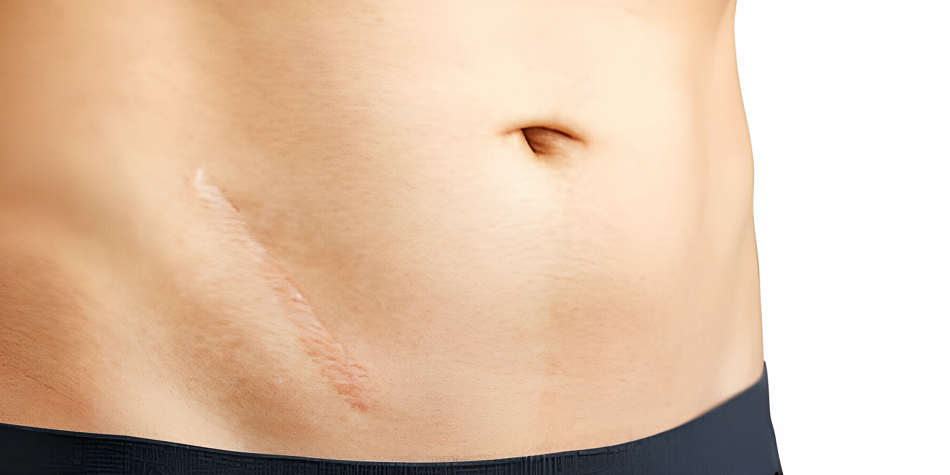 Keloids and Scars 
  Flatten and lighten raised scars or keloids with expert dermatological techniques for smoother, clearer skin.