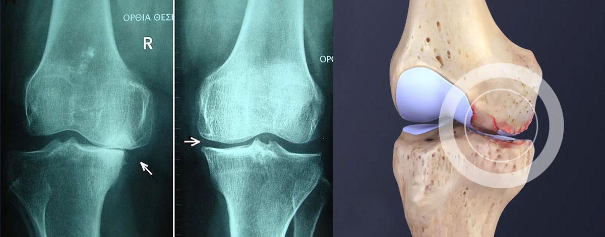 Knee Osteoarthritis 
  Comprehensive care for knee osteoarthritis—reducing pain, improving mobility, and slowing progression with personalized treatment plans.