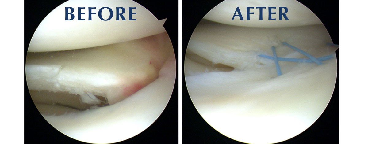 Meniscus Repair / Partial Meniscectomy
  Expert meniscus surgery to relieve pain and restore knee cushioning—tailored care for tears, improving mobility and joint health.