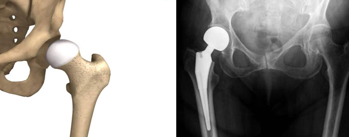 Partial Hip Replacement
  Replaces only the damaged part of the hip—commonly used for fractures, offering quicker recovery and improved function.