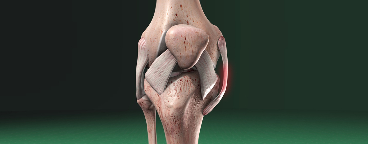 PCL / MCL / LCL Repair or Reconstruction
  Precise ligament repair for PCL, MCL, or LCL injuries—regain stability, reduce pain, and return to normal movement with expert care.