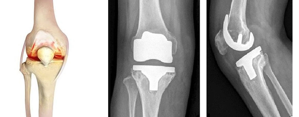 Knee Replacement
  Advanced total knee replacement for long-lasting relief from joint pain and arthritis—restoring mobility, improving quality of life, and helping you walk pain-free with confidence.