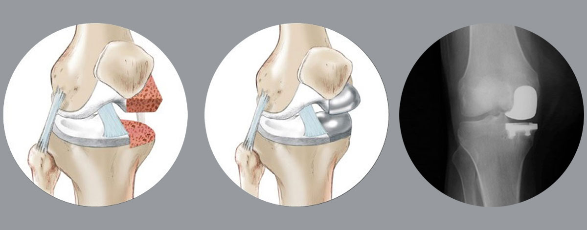 Unicompartmental Knee Replacement
  Minimally invasive partial knee replacement for early-stage arthritis—less pain, quicker recovery, and natural knee movement preserved with precise surgical care.